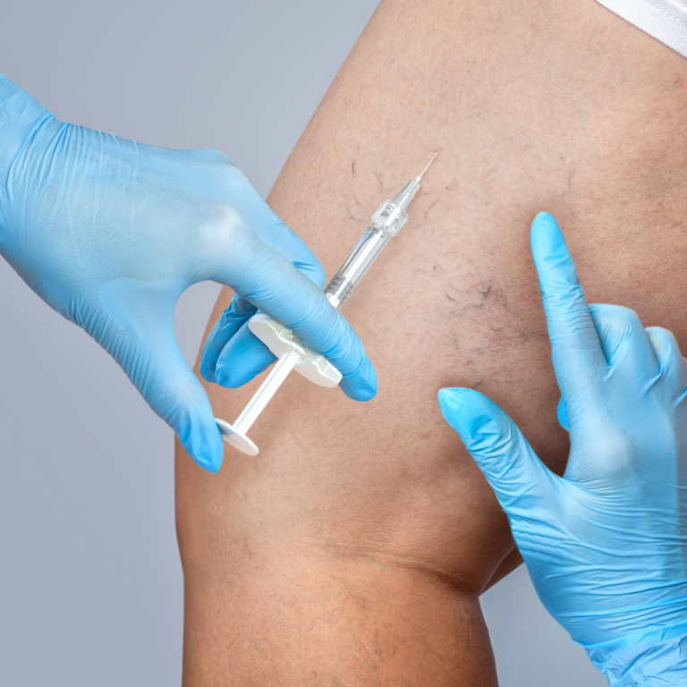 Compounded Sclerotherapy 768x768 1