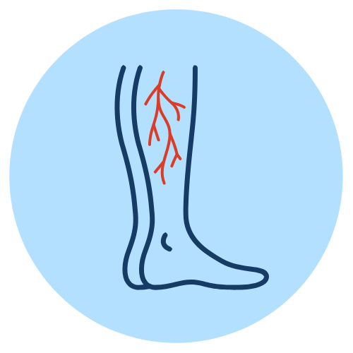 varicose and spider veins
