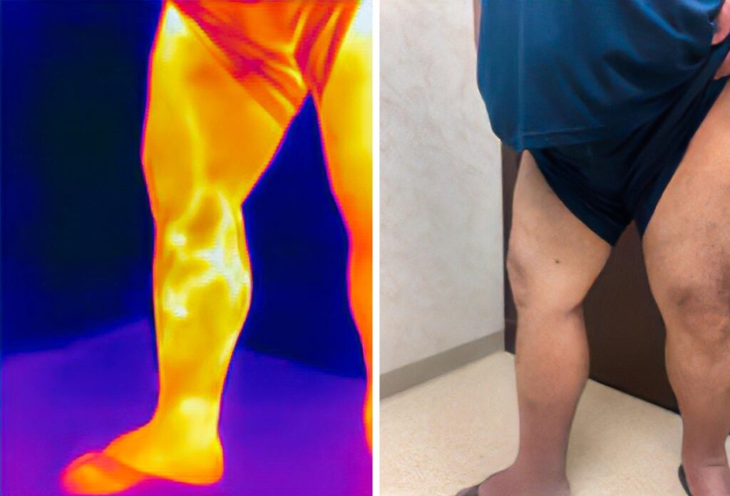 Venous Insufficiency 1 1030x700 1